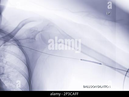 Angioplastie, Ballonangioplastie und perkutane transluminale Angioplastie (PTA) am linken Arm. Stockfoto