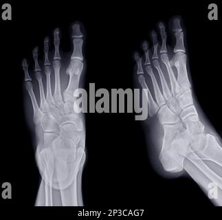 Fuß-Röntgenbild AP und schräge Ansicht isoliert auf schwarzem Hintergrund. Stockfoto