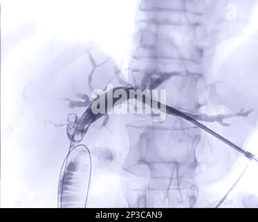 Röntgenbild der Pfortader nach ERCP-Doktor und laparoskopischer Cholezystektomie im modernen Operationssaal. Stockfoto