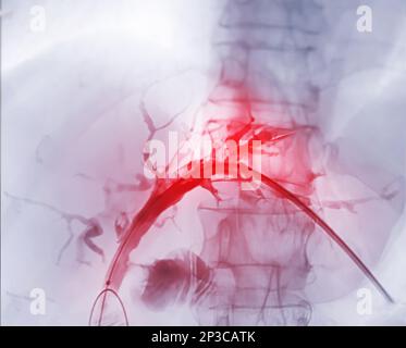 Röntgenbild der Pfortader nach ERCP-Doktor und laparoskopischer Cholezystektomie im modernen Operationssaal. Stockfoto