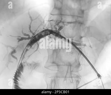 Röntgenbild der Pfortader nach ERCP-Doktor und laparoskopischer Cholezystektomie im modernen Operationssaal. Stockfoto