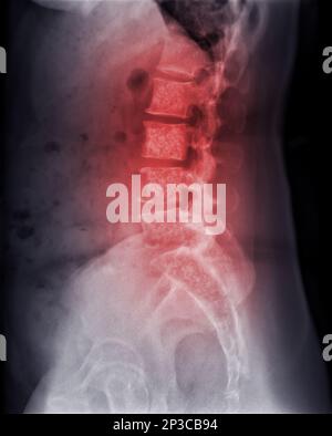 Röntgenbild der Lambosakralwirbelsäule oder der L-S-Wirbelsäule mit Knochenmetastasen. Stockfoto