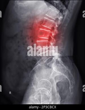 Röntgenbild der Lambosakralwirbelsäule oder L-S-Wirbelsäule mit Läsion bei L3. Stockfoto