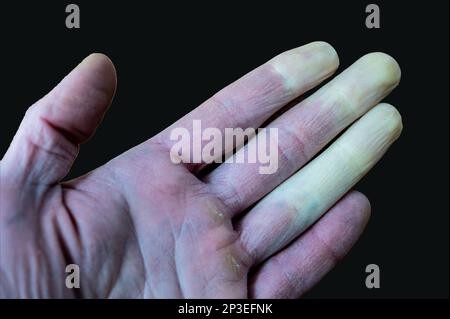 Eine erfrierte männliche Hand mit Raynaud-Syndrom, Raynaud-Phänomen oder Raynaud-Krankheit isoliert auf schwarzem Hintergrund. Stockfoto