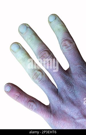 Eine erfrierte männliche Hand mit Raynaud-Syndrom, Raynaud-Phänomen oder Raynaud-Krankheit isoliert im Weißen Hintergrund. Stockfoto