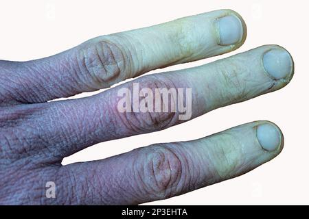 Eine erfrierte männliche Hand mit Raynaud-Syndrom, Raynaud-Phänomen oder Raynaud-Krankheit isoliert im Weißen Hintergrund. Stockfoto