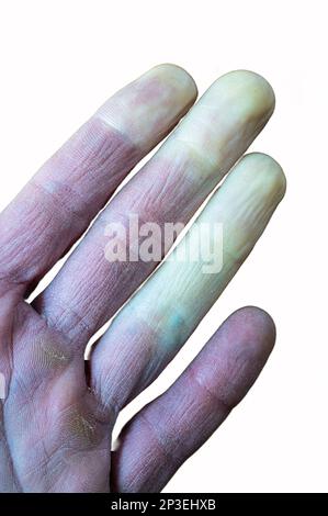 Eine erfrierte männliche Hand mit Raynaud-Syndrom, Raynaud-Phänomen oder Raynaud-Krankheit isoliert im Weißen Hintergrund. Stockfoto