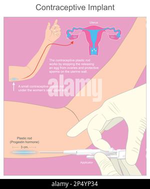Kontrazeptivum-Implantat. Eine kleine kontrazeptive Kunststoffstange unter der Haut des Oberarms der Frau. Stock Vektor