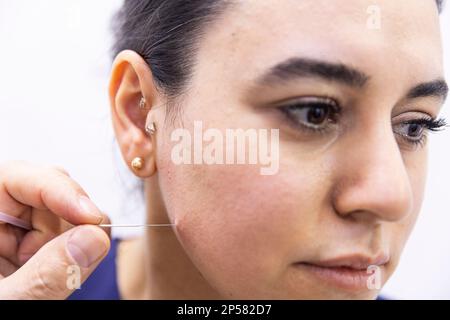 Behandlung mit trockenen Nadeln. Ein Porträt einer kleinen Akupunkturnadel, die in das Gesicht einer Person neben der Nase steckt, um Schmerzen zu heilen, Stress zu lindern oder ein anderes m Stockfoto