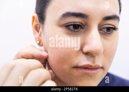 Behandlung mit trockenen Nadeln. Ein Porträt einer kleinen Akupunkturnadel, die in das Gesicht einer Person neben der Nase steckt, um Schmerzen zu heilen, Stress zu lindern oder ein anderes m Stockfoto