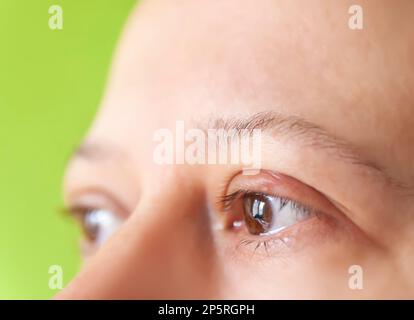 Gerstenkrankheit im Auge. Wunde Augenlider. Stockfoto