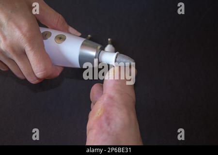 Bild einer Mini-Bohrmaschine, die von einer Kosmetikerin verwendet wird, während sie abgestorbene Haut von einem großen Zeh entfernt. Kallusentfernung. Stockfoto