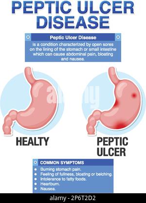 Peptisches Ulkus erklärt Infografik Illustration Stock Vektor