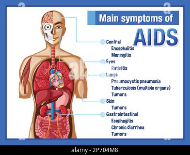 Informatives Poster der Hauptsymtome der AIDS-Illustration Stock Vektor