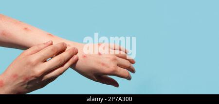 Affen-Pocken-neue Krankheit gefährlich auf der ganzen Welt. Patient mit Affenpocken. Schmerzhafter Ausschlag, rote Flecken Bläschen an der Hand. Hautausschlag, menschliche Hände Stockfoto