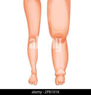 Fussödeme. Geschwollene Beine und Knöchel, Vektor-Lymphödem oder Lymphödem-Erkrankung des Lymphsystems. Karikatur menschliche Füße Vergleich, gesund und geschwollen l Stock Vektor