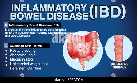 Chronisch entzündliche Darmerkrankungen (IBD) Infografik Illustration Stock Vektor