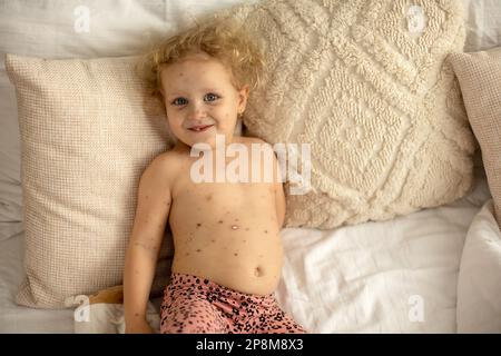 Kleines Kleinkind mit Windpocken im Bett, Spielen zu Hause, Quarantäneisolation während der Krankheit, Varicella-Zoster-Virus oder Windpocken-Blasenausschlag Stockfoto