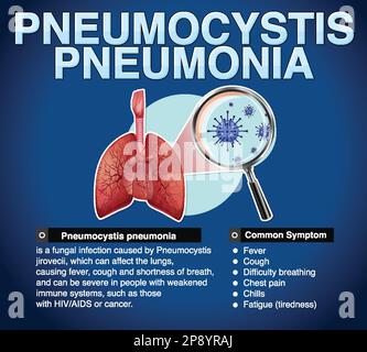 Informationsposter zur Illustration der Pneumocystis-Pneumonie Stock Vektor