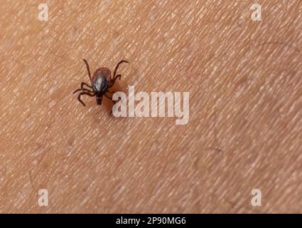 Infizierte weibliche Hirschzecke auf behaarter menschlicher Haut. Ixodes ricinus. Parasitäre Milbe. Acarus. Gefährliches Bissinsekt auf Epidermis-Detailhintergrund. Disg Stockfoto