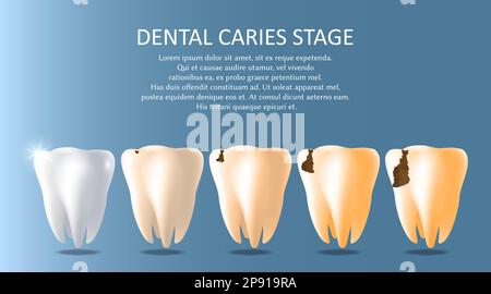 Zahnkaries Stadien Vektor medizinische Poster Banner Vorlage Stock Vektor