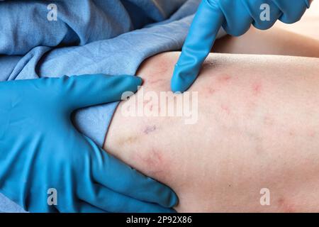 Ein Phlebologe untersucht einen Patienten mit Krampfadern am Bein. Beinschmerzen. Phlebologie. Venöse Pathologien der unteren Extremitäten. Menschliches Gefäß, arter Stockfoto