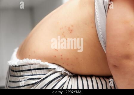 Der Rücken eines kleinen Kindes mit rotem Ausschlag. Baby mit roten Flecken Blasen auf der Haut. Nahaufnahme von schmerzhaftem Ausschlag. Gesundheitsproblem. Röteln, Windpocken, Scharlach Stockfoto