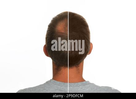 Mann mit Haarausfall vor und nach Behandlung auf weißem Hintergrund, Collage. Ein besuchender Trichologe Stockfoto