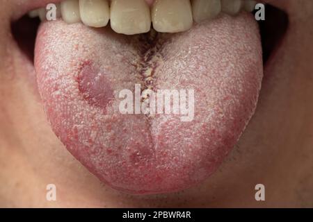 Candida-Hefe verdeckte Zunge eines Weißen mit offenem Mund. Nahaufnahme, unerkennbares Gesicht. Stockfoto