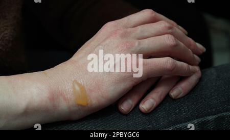 Nahaufnahme einer Frauenhand mit Blasenbildung von einer kochenden Wasserverbrennung, einer Hautverletzung, einer 1.- oder 2-Grad-Verbrennung. Schmerzhafte Wunde. Thermische Verbrennung. Wasserblase Stockfoto