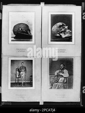 Chirurgisches Foto... Erstellt unter Aufsicht von ... Kriegsministerium, Büro des Generalchirurgen, Armeemuseum. Fotosammlung Zum Bürgerkrieg . Behinderte Veteranen, 1860-1870, Skulls, 1860-1870, Soldaten, 1860-1870, Usa, Geschichte, Bürgerkrieg, 1861-1865, Medizinische Aspekte, USA, Geschichte, Bürgerkrieg, 1861-1865, Militärpersonal. Stockfoto