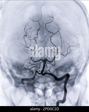 Zerebrale Angiographie Imageor potesteriore Arteria cerebri aus der Fluoroskopie in der Interventionsradiologie mit Darstellung der Arteria basilaris. Stockfoto