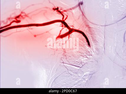 Bild der Angioplastie, Ballonangioplastie und perkutanen transluminalen Angioplastie (PTA). Stockfoto