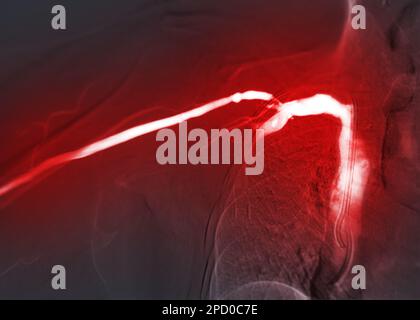 Bild der Angioplastie, Ballonangioplastie und perkutanen transluminalen Angioplastie (PTA). Stockfoto