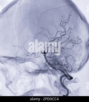 Zerebrale Angiographie im Bild oder Potesteriore Arteria cerebri aus der Fluoroskopie in der Interventionsradiologie mit Darstellung der Arteria cerebri. Stockfoto