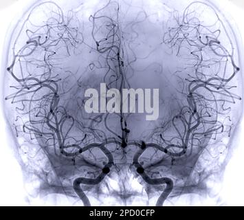 Zerebrale Angiographie aus der Fluoroskopie in der Interventionsradiologie, die die Hirnarterie zeigt. Stockfoto