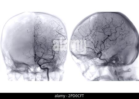 Zerebrale Angiographie aus der Fluoroskopie in der Interventionsradiologie, die die Hirnarterie zeigt. Stockfoto