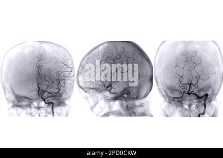 Zerebrale Angiographie aus der Fluoroskopie in der Interventionsradiologie, die die Hirnarterie zeigt. Stockfoto