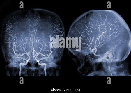 Zerebrale Angiographie aus der Fluoroskopie in der Interventionsradiologie, die die Hirnarterie zeigt. Stockfoto