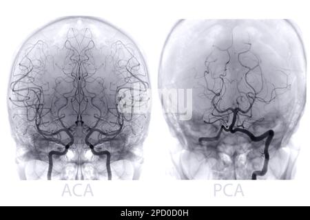 Zerebrale Angiographie aus der Fluoroskopie in der Interventionsradiologie, die die Hirnarterie zeigt. Stockfoto