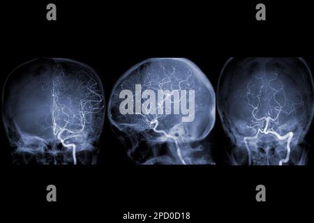 Zerebrale Angiographie aus der Fluoroskopie in der Interventionsradiologie, die die Hirnarterie zeigt. Stockfoto