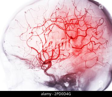 Zerebrale Angiographie aus der Fluoroskopie in der Interventionsradiologie, die die Hirnarterie zeigt. Stockfoto