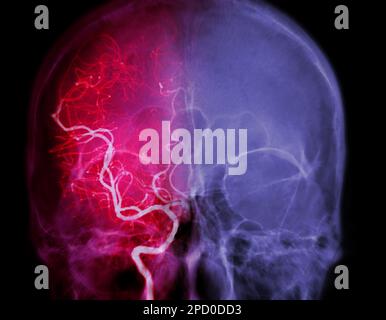 Zerebrale Angiographie aus der Fluoroskopie in der Interventionsradiologie, die die Hirnarterie zeigt. Stockfoto