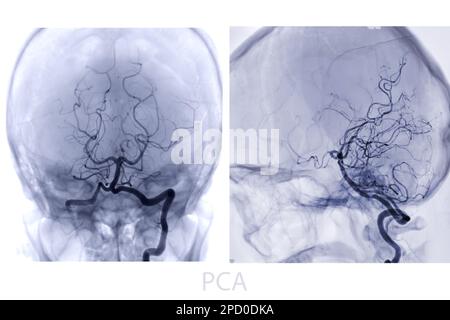 Zerebrale Angiographie aus der Fluoroskopie in der Interventionsradiologie, die die Hirnarterie zeigt. Stockfoto