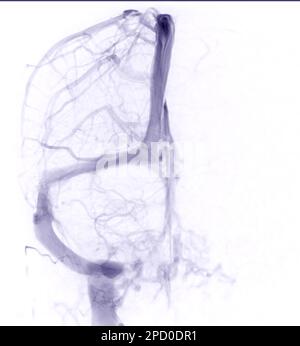 Zerebrale Venograpie zur Diagnose einer zerebralen Venenthrombose Stockfoto