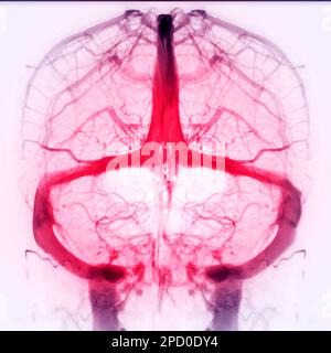 Zerebrale Venograpie zur Diagnose einer zerebralen Venenthrombose Stockfoto