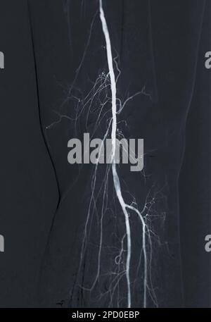 Angiogramm der A. femoralis oder Angiographie Stockfoto