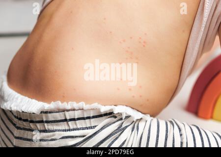 Der Rücken eines kleinen Kindes mit rotem Ausschlag. Baby mit roten Flecken Blasen auf der Haut. Nahaufnahme von schmerzhaftem Ausschlag. Gesundheitsproblem. Röteln, Windpocken, Scharlach Stockfoto