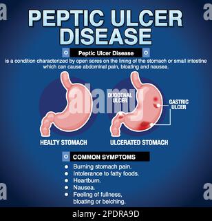 Peptisches Ulkus erklärt Infografik Illustration Stock Vektor