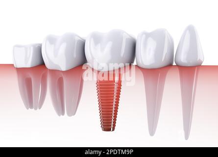 Molaren und Implantate im Kieferknochen. 3D-Rendern. Stockfoto